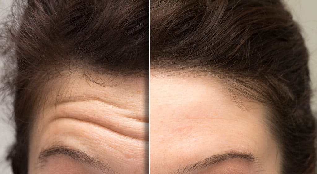 Before and After Botox Treatment Photos | Vibe Aesthetics in Hood River, OR