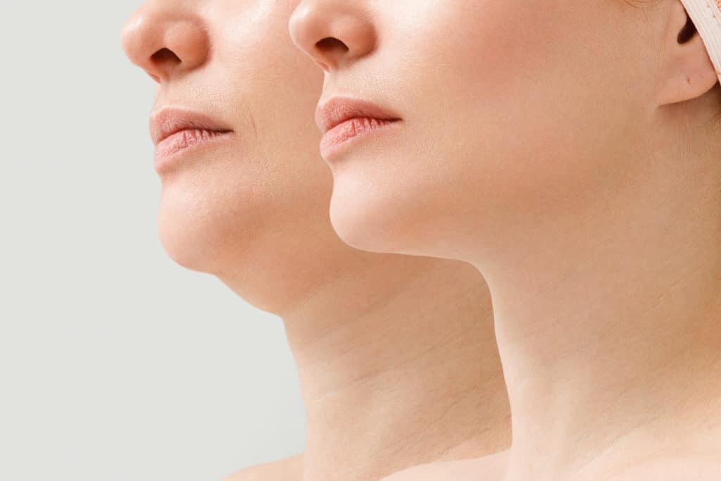 Before and After Image of Kybella Treatment | Vibe Aesthetics in Hood River, OR