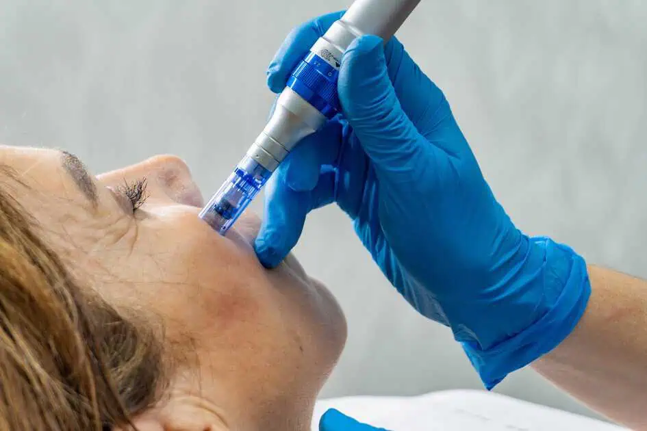 Microneedling in Hood River, OR by Vibe Aesthetics